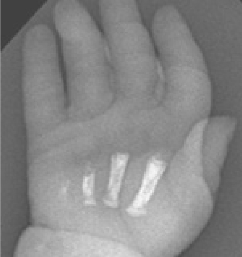 Infant hand after 2.9 weeks